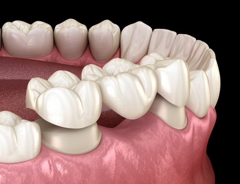 All Porcelain Dental Bridge